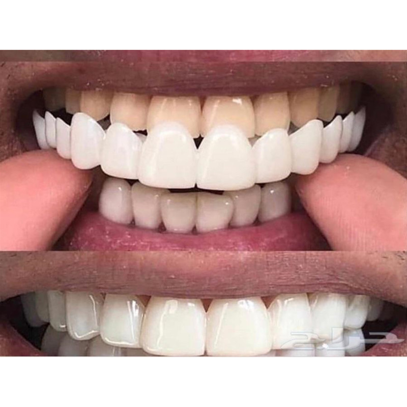 柔らかいシリコーンゲルの口腔下,偽の歯のカバー,笑顔,歯科用 - Teeth Whitening Moulds のレビューと価格