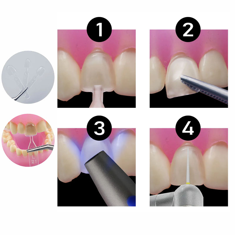32個/セット 複合レジンモールド 光硬化 オートクレーブ対 - Teeth Whitening Moulds のレビューと価格