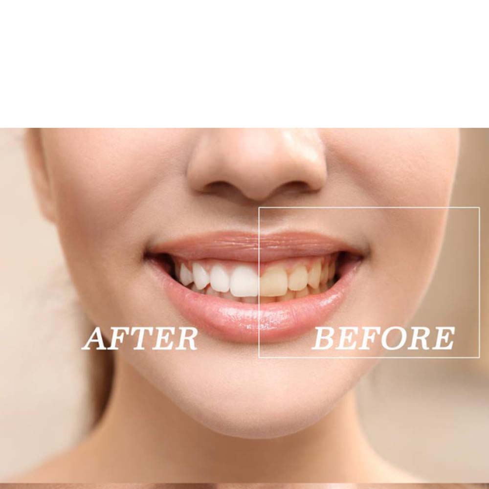 歯のホワイトニングキット,高品質の製品,過酸化物,明るい白, - Teeth Whitening Kit のレビューと価格