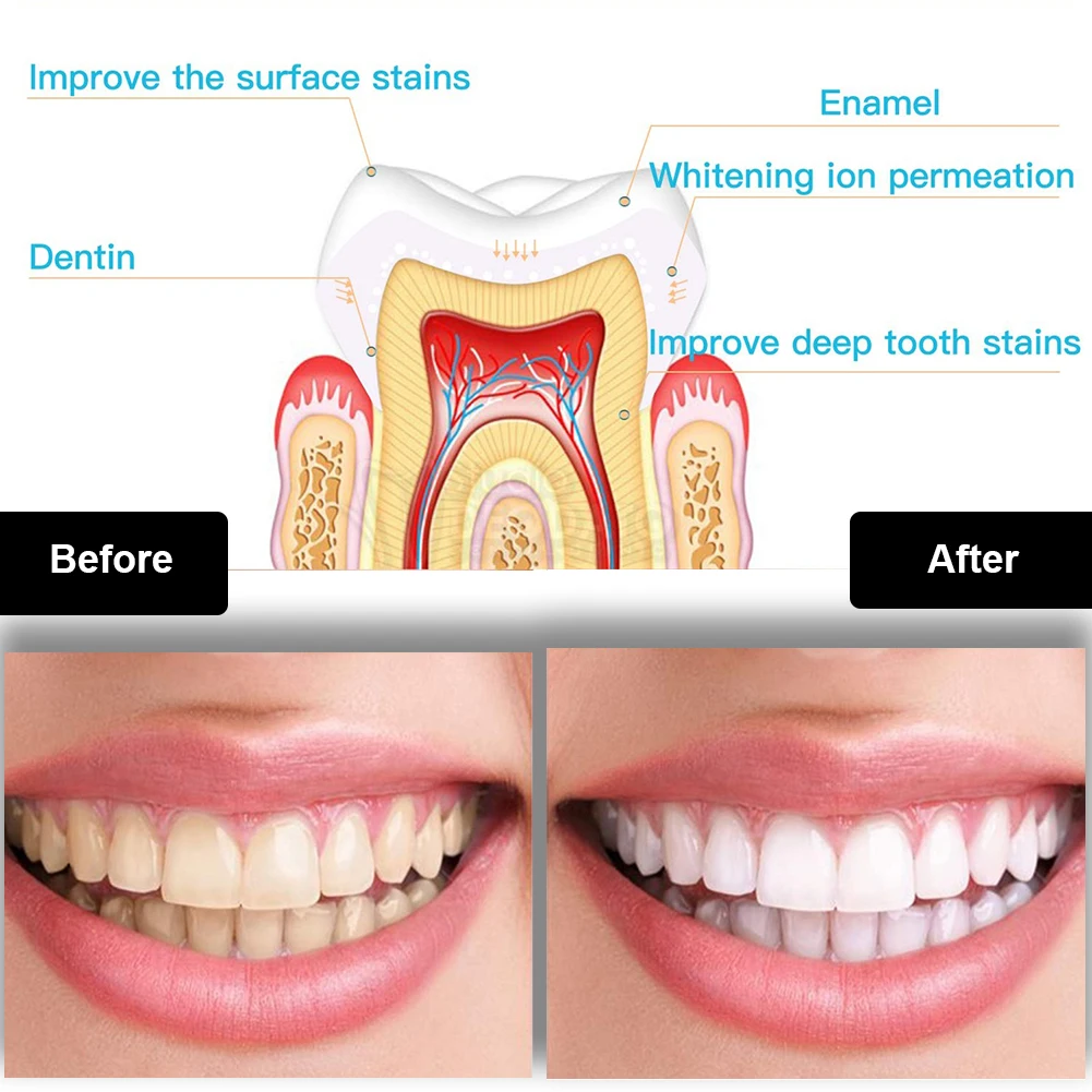 歯科歯ホワイトニングキットミニ 16 LED コールドライト - Teeth Whitening Pens のレビューと価格