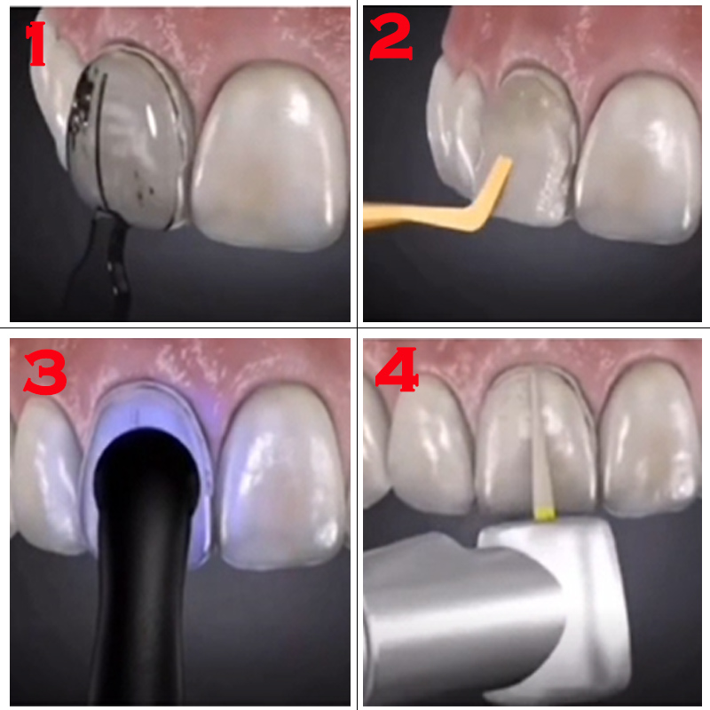 高温滅菌可能な歯科用ベニア型。前歯の審美性を高めるためのベニ - Teeth Whitening Moulds のレビューと価格