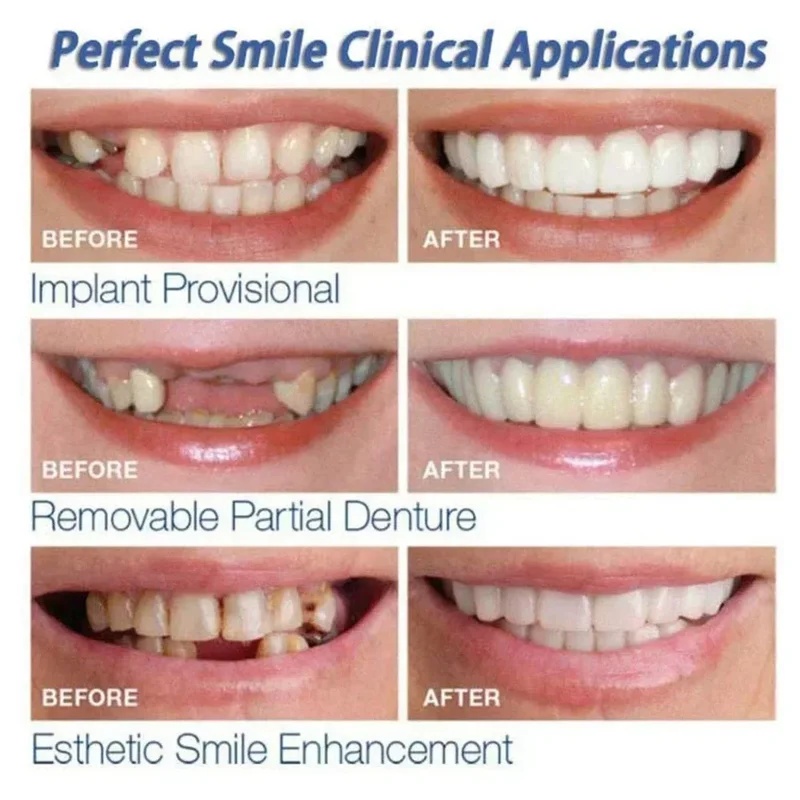 装着式のベニア歯キット。調整可能な美容用歯科ベニア。男性・女 - Teeth Whitening Kit のレビューと価格